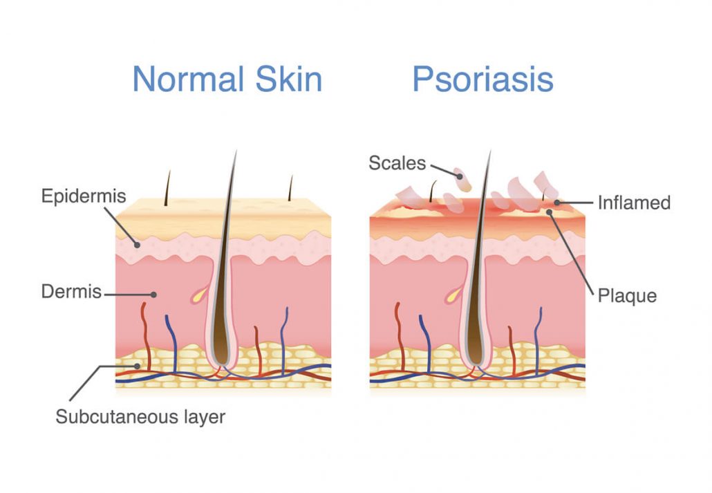 Tratamiento Natural Para Psoriasis Desc brelo En El Blog De LNT tratamiento-natural-para-psoriasis-desc-brelo-en-el-blog-de-lnt